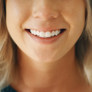Single Top or Bottom Veneer - Image 5