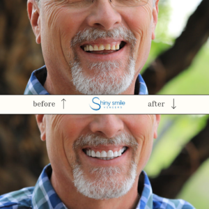 Single Top or Bottom Veneer - Image 6